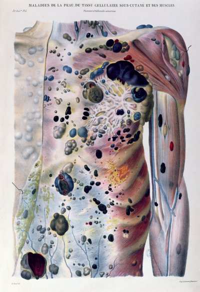 Tumours and cancerous tubercles, from 